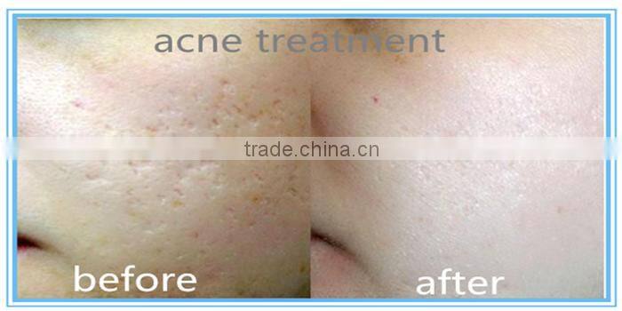 2940 erbium yag medical laser scar removal machine