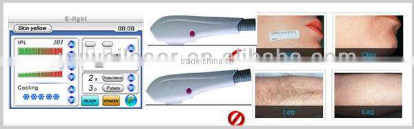 ipl remove leg hair machine