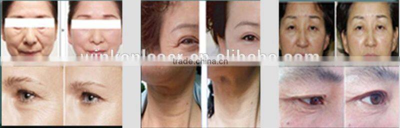fractional rf / rf fractional micro needle / rf face lifting machine