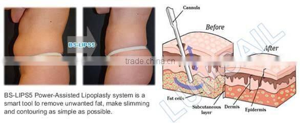 Lipo Laser RF Cavitation Liposuction Machine