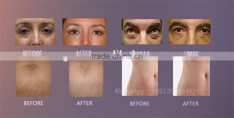 CDT CO2 Carboxy therapy /CO2 Carboxytherapy carboxy therapy equipment