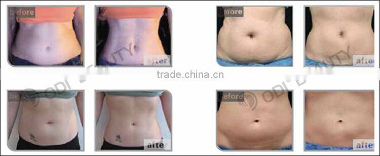 Alibaba express ultrasound hifu body slimming shaping equipment