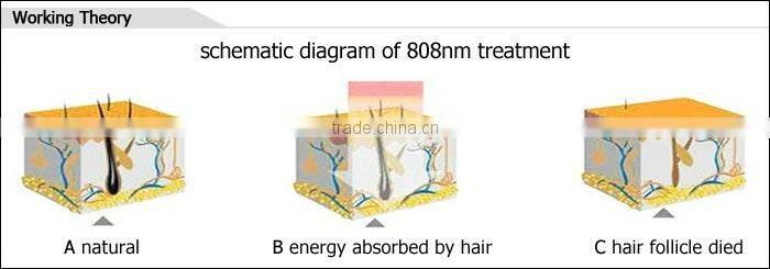 Hair removal beauty equipment/portable and professional laser diodo 808 nm machine