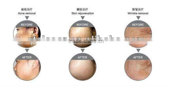 Hot sale medical led light therapy