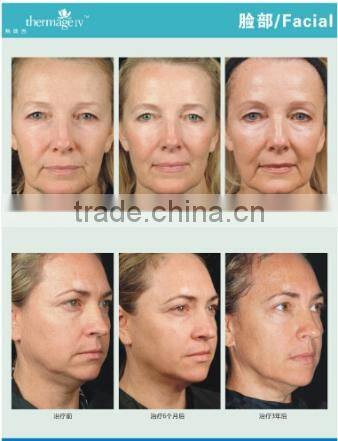 AYJ-C19(CE) Dot matrix portable rf thermagic galvanic facial machine