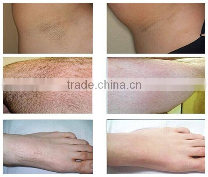 Professional OPT (Optimal Pulse Technology) Chin Hair Removal