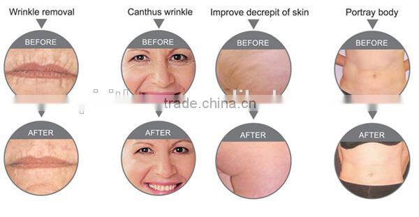 Best High Quality Mini RF Equipment