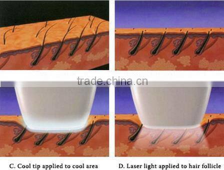 Home Use Portable Laser Hair Removal System Device 808nm Laser Diode