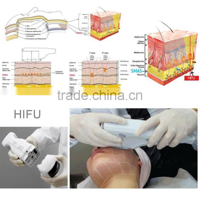 cavitation hifu High intensity focused ultrasound face lifting machine Cynthia RU1123B