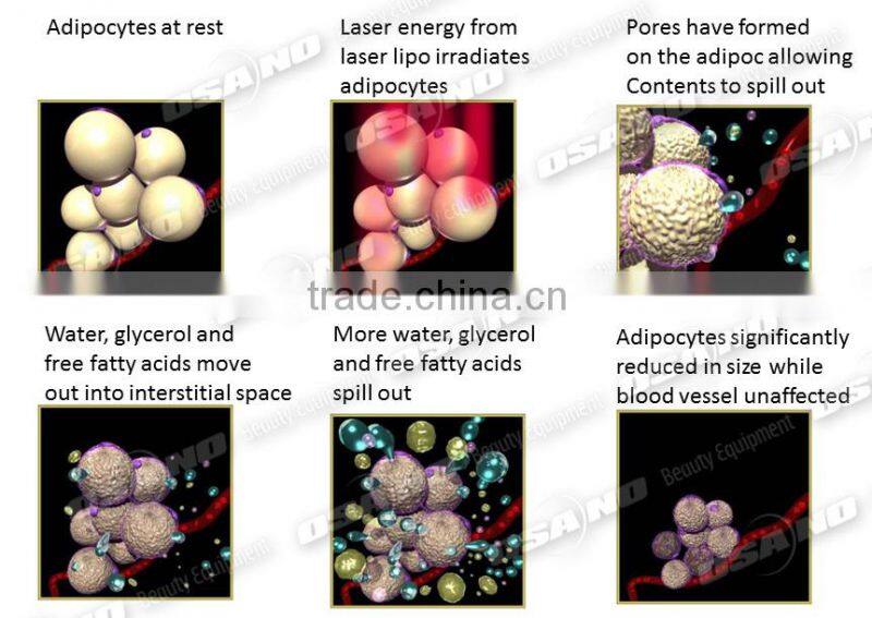 LM-S650B Fat Burning Vacuum Cavitation RF cryolipolysis lipo laser