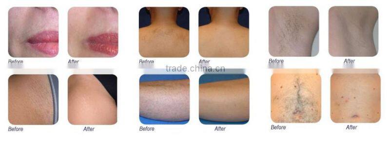 808T-3 Health care appliance vertical diode laser diode laser 808 and 808 diode laser