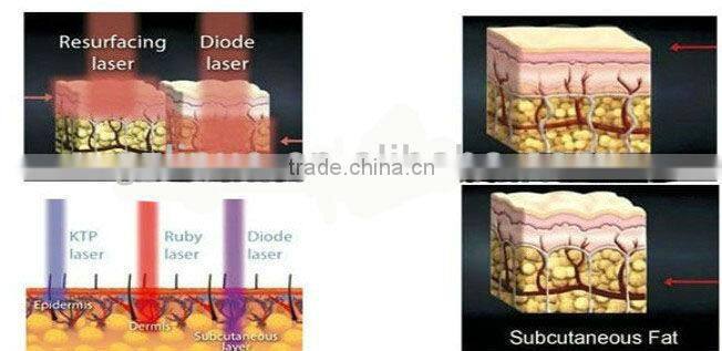 NO.1 2013-2017 10 paddles !!!popular 650nm laser, lipolaser equipment ( Amazing Result at Fat loss!!!!!!!!!)