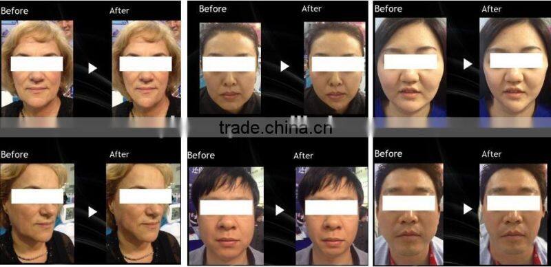 AYJ-T05 (CE)rf fractional micro needle/fractional rf microneedle machine/rf machine for home use