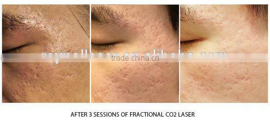 Skin Tightening Machine 10.4" Color Touch Screen 40W Fractional Co2 Laser