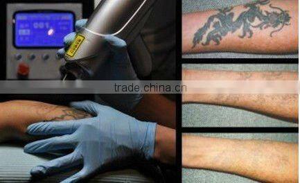 Bid discount 850 USD for Portable laser tattoo removal equipment