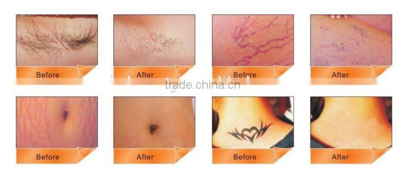 Hot Selling Proffessional Effectiveness IPL Radio Frequency Rf Skin Rejuvenation