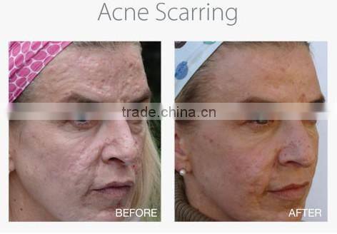 12 needles Mini automatic Microneedle Skin Needling