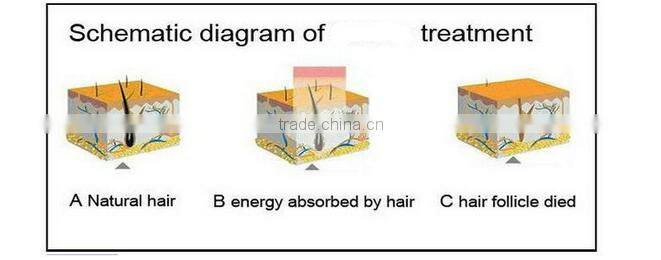 Promotion weifang huamei medical CE ipl hair removal machine for home use