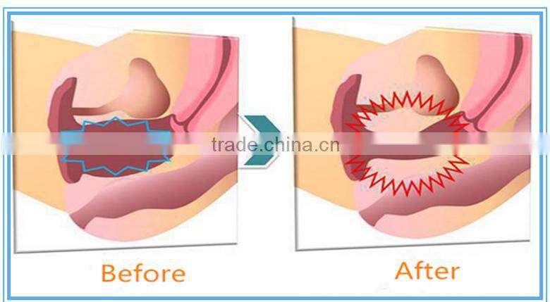 medical equipments co2 laser vaginal rejuvenation