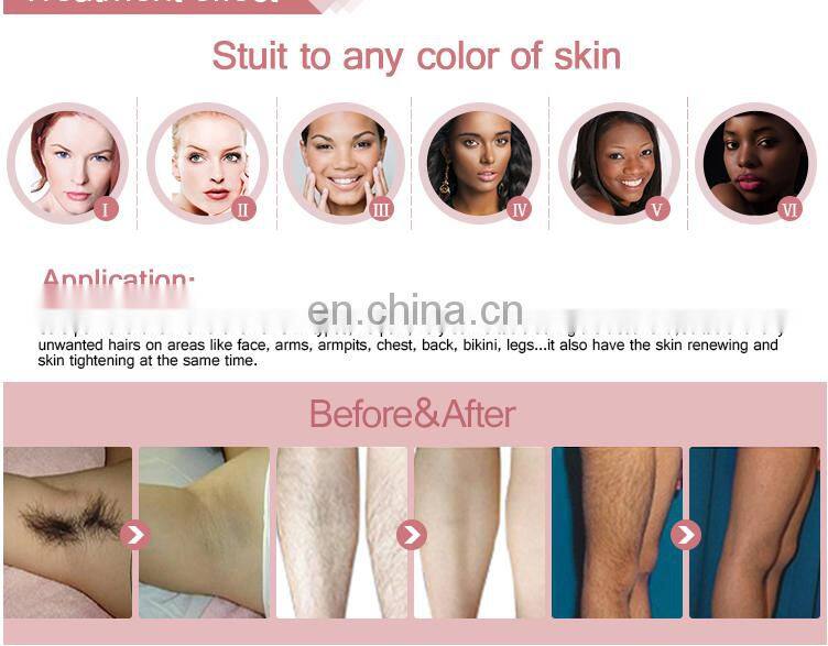 Trio Laser Hair Removal 755nm 808nm 1064nm Hair Removal Laser