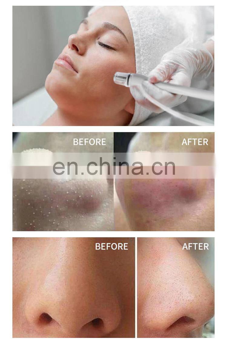 Anti-aging Diamond Dermabrasion Machine SPA9.0 Small Bubble Cleansing Microdermabrasion Facial Instrument Deep Moisturizing