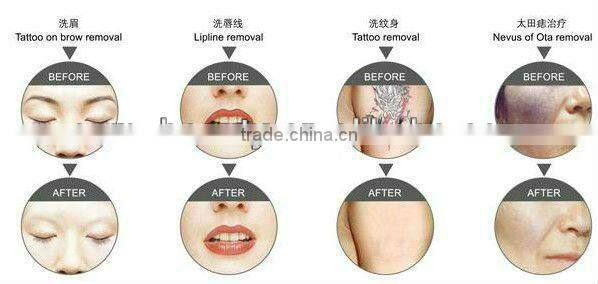 Big discount nd yag laser eye line eyebrow tattoo removal machine D006