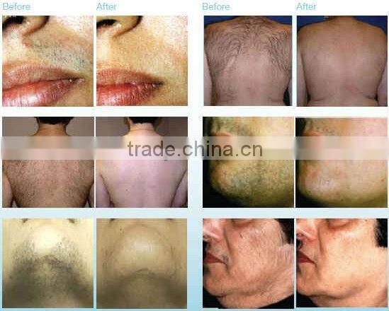 Factory promotion!!! professional beauty machine nd yag laser varicose veins removal