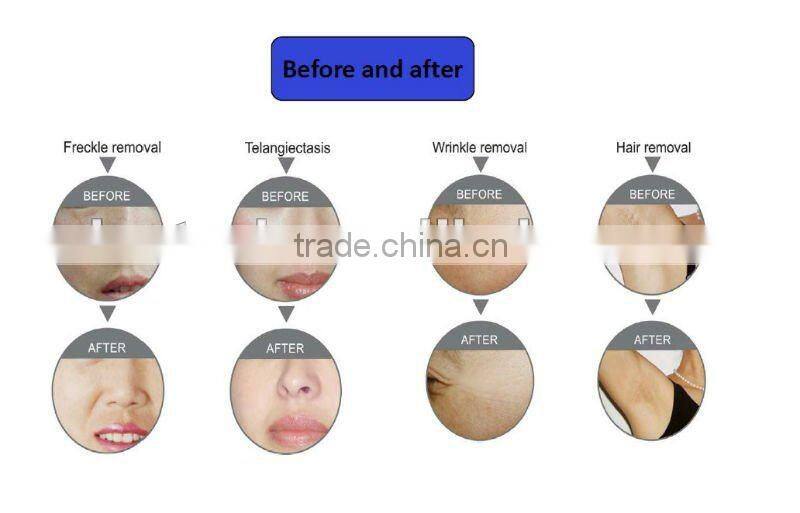 high power elight laser for hair removal and skin treatment