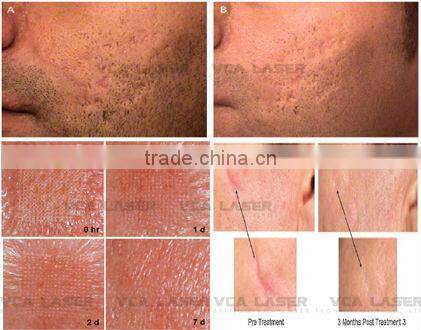 nd yag laser / elight ipl rf nd yag laser / q switch nd yag laser