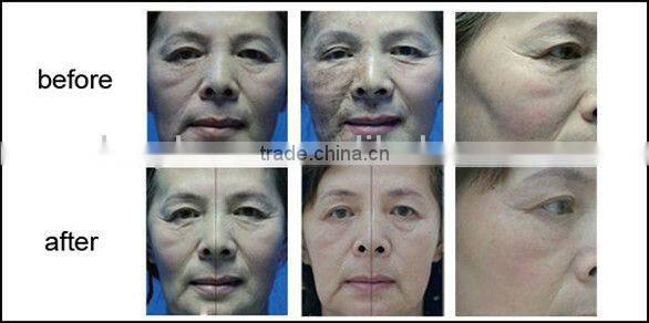 10600nm laser equipment co2 fractional