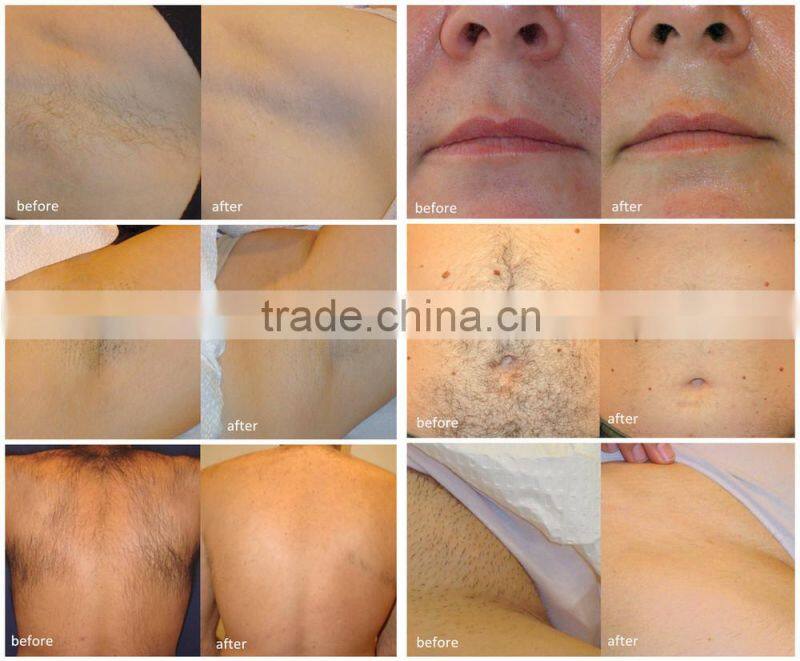 zema diode hair removal laser diode laser equipment diode hair removal laser