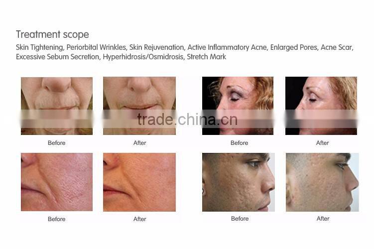 Easy to delegates ergonomically stretch mark radiofrequency machine for skin tightening