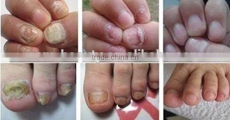 Beauty care Long pulse China laser hair removal equipment,laser depilator machine from Beijing factory -P003