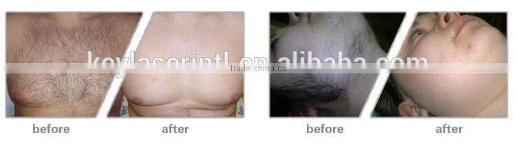 Manufacturer hair removal home use diode laser soprano ice