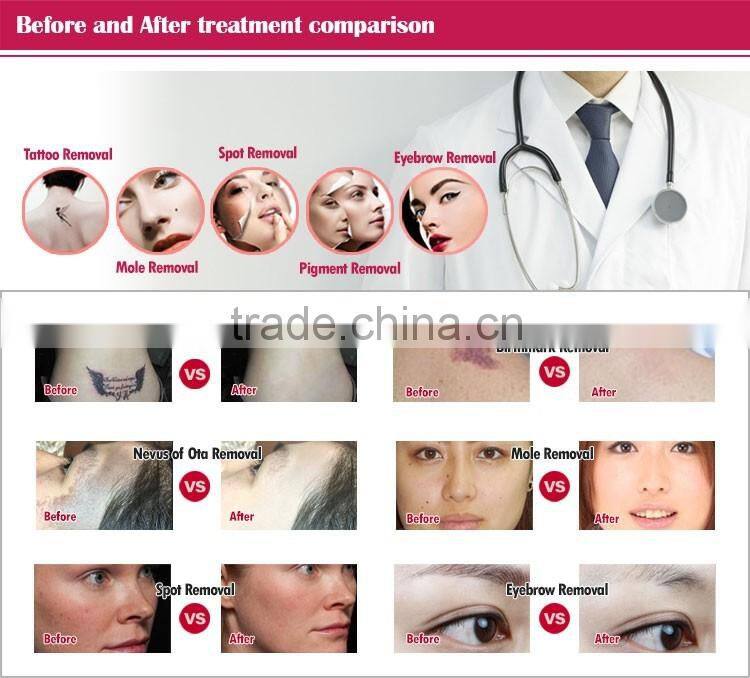 Good feedback tattoo removal q-switch nd yag laser