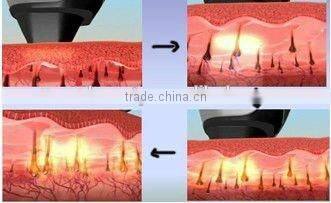 2015 Most Popular!!!Factory Price 808nm Diode Laser Hair Removal