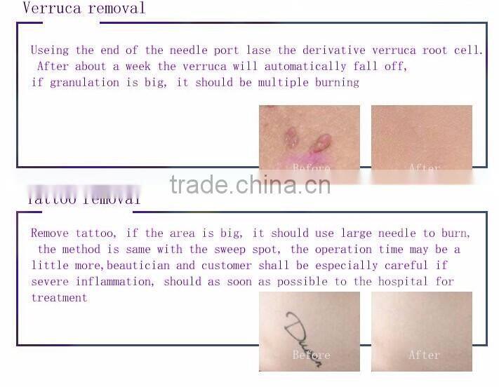Top selling skin mole removal machine