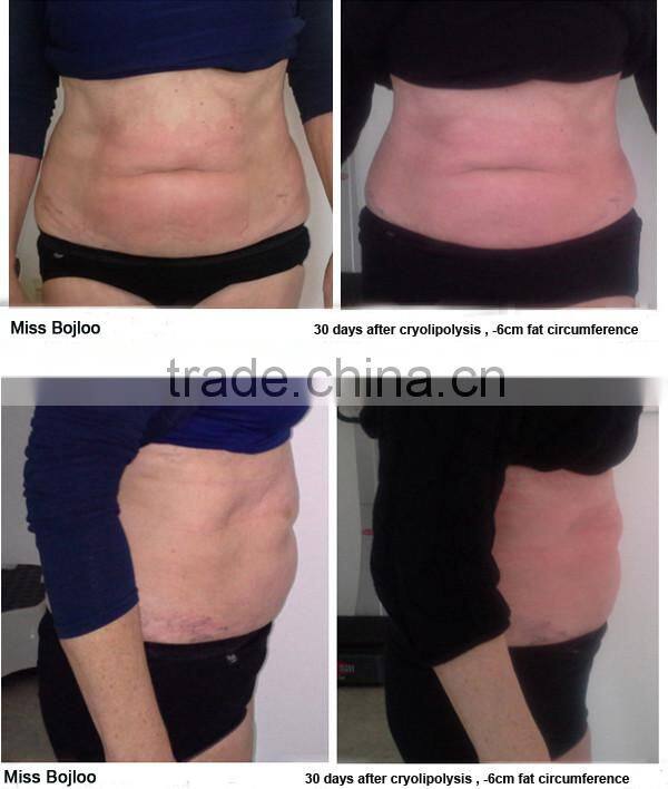 Most popular medical slimming cryogenic liposuction, cryogenic lipolysis