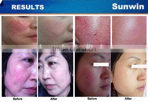 portable spider vein laser removal machine