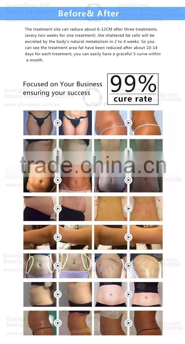 New focused ultrasound ultrashape hifu slimming machine