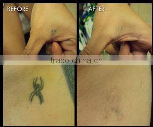 Best Selling Q-switch ND YAG laser tattoo tattooing 1320nm nd-yag laser china yag laser