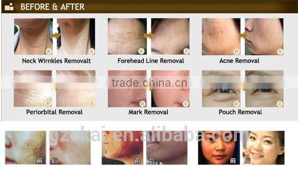 Vibrating microneedle derma roller therapy electrical derma stamp pen MYM professional version