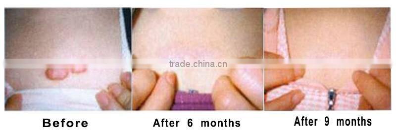 Newest Generation!! Beauty Device Fractional CO2 Laser Equipment Vaginal Tightening Machine with FDA