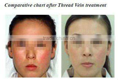 Advanced cooling system painless permanent laser shr IPL hair removal machine