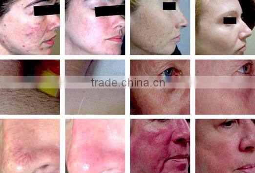 hair remvoal ipl facial beauty machine for skin rejuvenation with CE approval