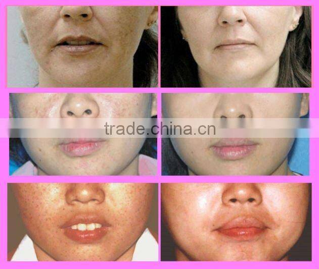 Skin Rejuvenation and Hair Removal IPL Beauty Machine