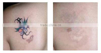 ND Yag Brown Hair Removal Physiotherapy Device