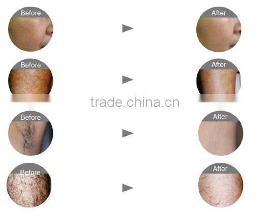 Newest shr machine for super hair removal/IPL+EPL beauty machine/shr multifuntion device