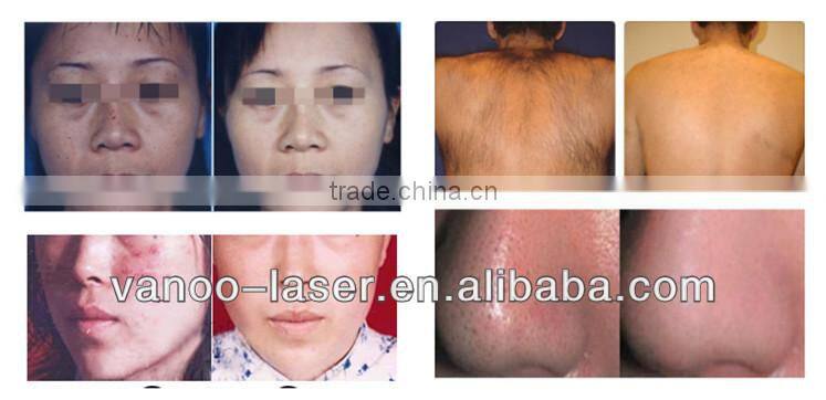 Portable Skin Rejuvenation Vascular Removal Elight Hair Removal Machine