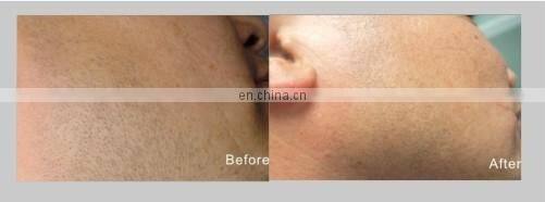 GSD Star product!!! Ipl and professional hair removal beauty machine with CE